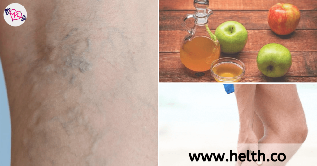 Apple cider vinegar for varicose veins 4