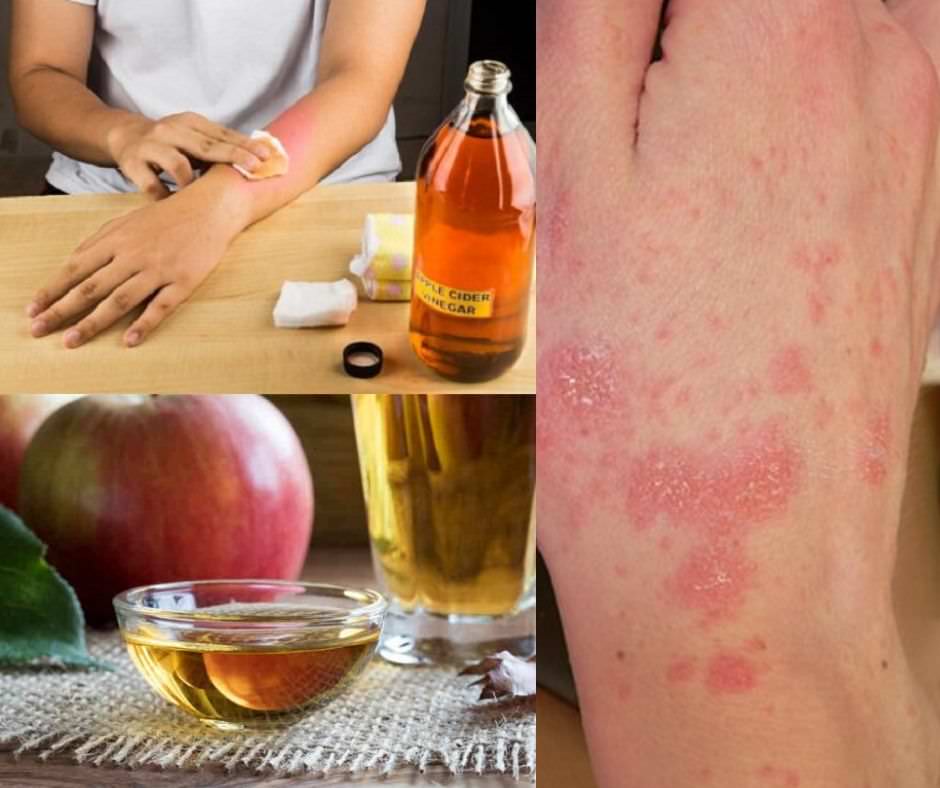 Does Drinking Apple Cider Vinegar for Scabies Help?