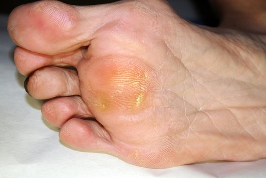 Home Remedy for Callus1