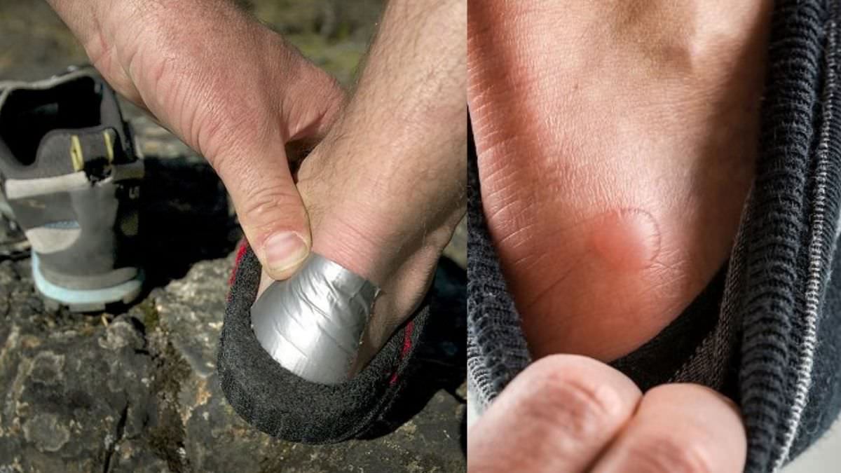 Duct Tape for Blisters Duct Tape Remedy for Blisters ⋆ The Health Exchange