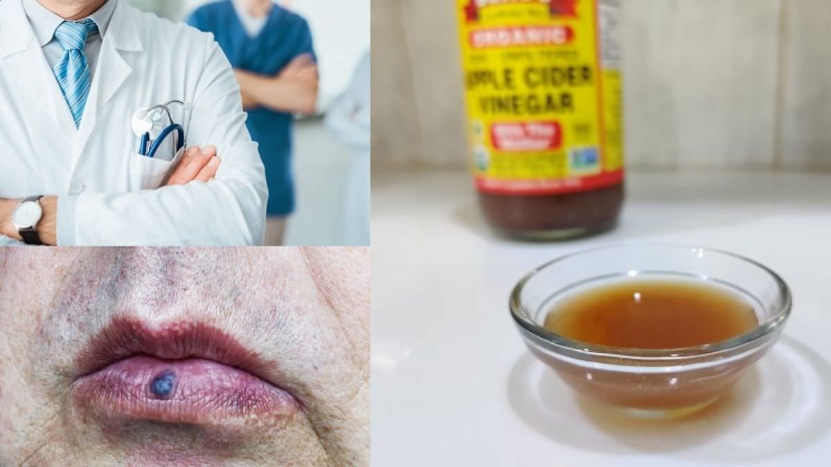 Venous Lake Lip Treatment | Home Remedies for Venous Lake ⋆ The Health ...