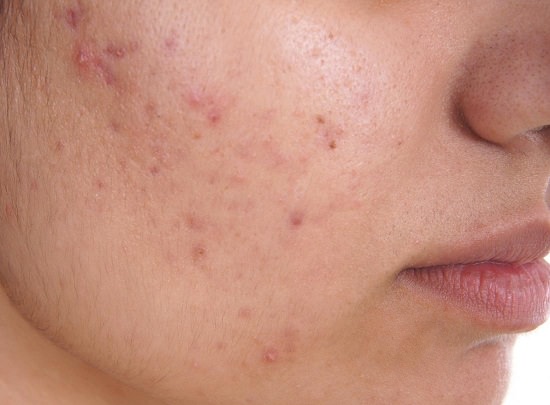 Does Dry Skin Cause Acne1