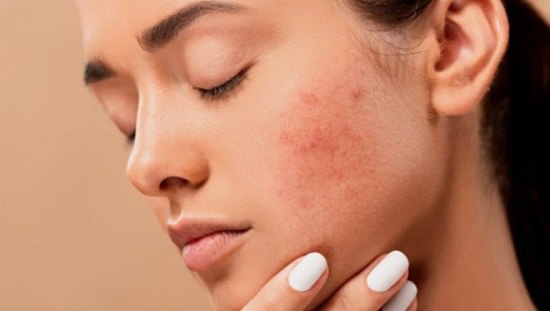 Does Dry Skin Cause Acne3