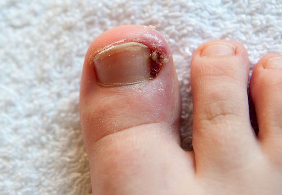 Essential Oils for Ingrown Toenails1