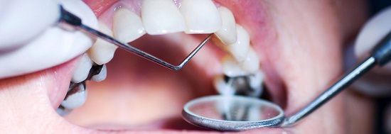 Occlusal Cavity4