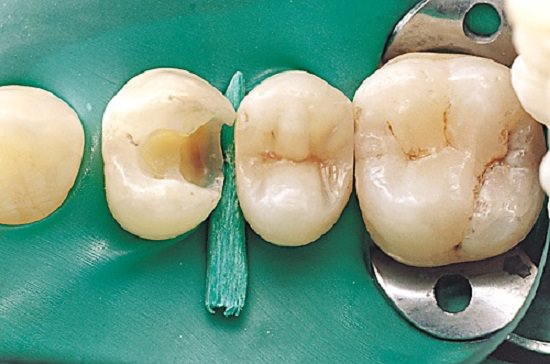 Occlusal Cavity2