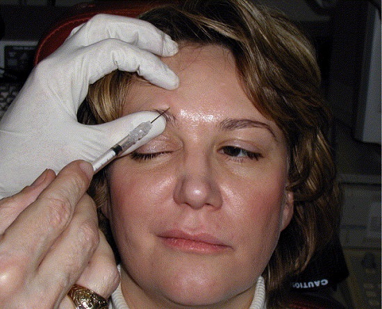 Side Effects of Botox Injections for Hemifacial Spasm2