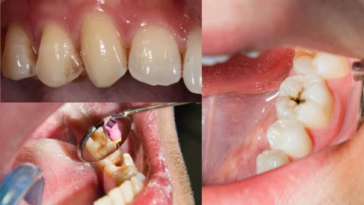 Tooth Cavity Vs A Stain | Treatments for Tooth Cavity ⋆ The Health Exchange